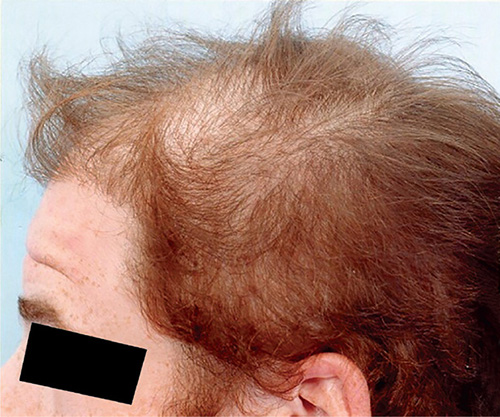 Female Pattern Baldness